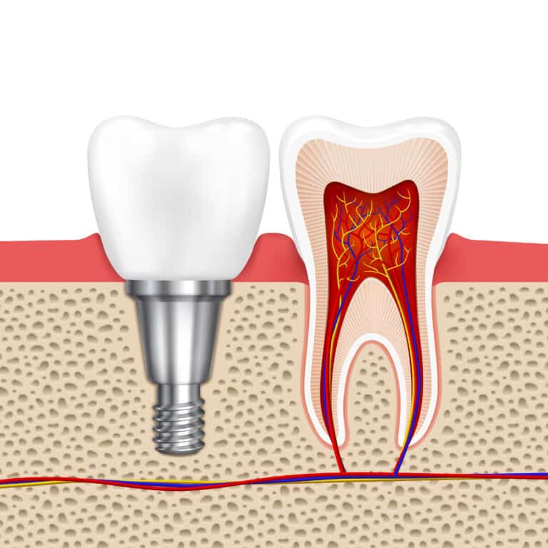 Discover how long it takes to recover from a root canal, what to expect during the healing process, and tips for a quick recovery.
