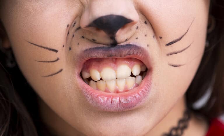 Black Spots on Teeth That Are Not Cavities