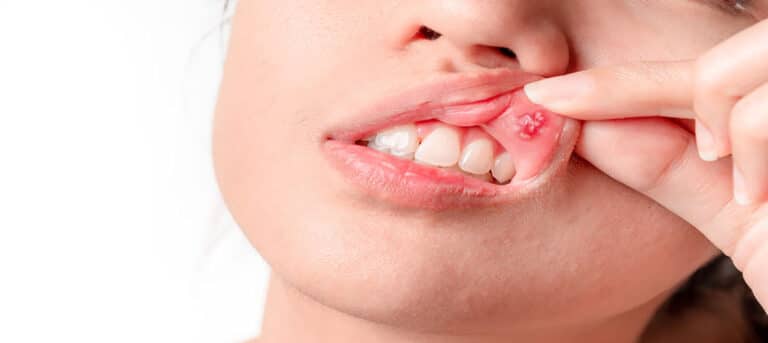 Heal a Cut in Your Mouth Overnight