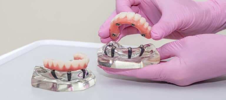Arch in Dental Implants