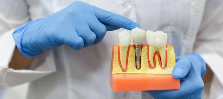 Loose Dental Implant Crown