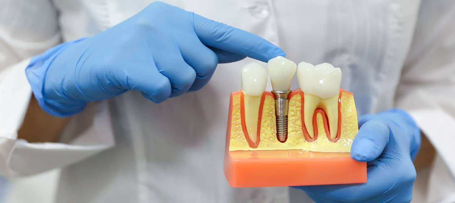 Symptoms of a Loose Dental Implant Crown