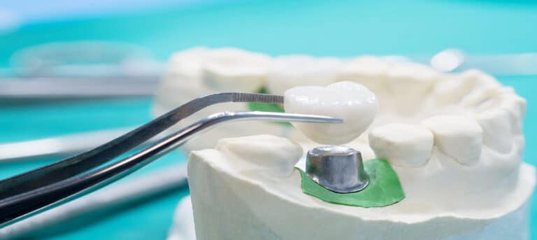 How Long Do Dental Crowns Last