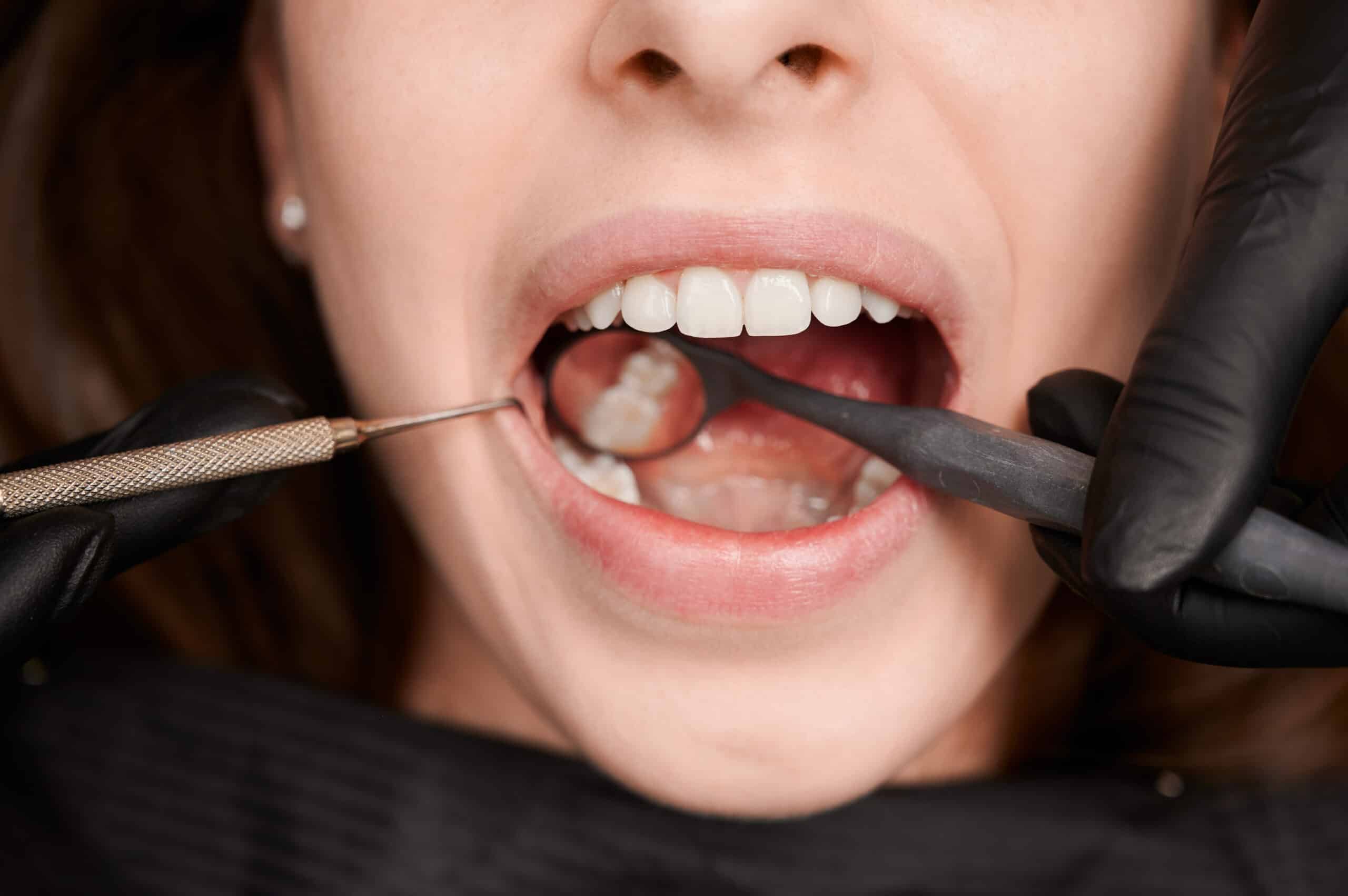 Tooth Decay Under a Crown: Causes, Warning Signs, and Treatment Options